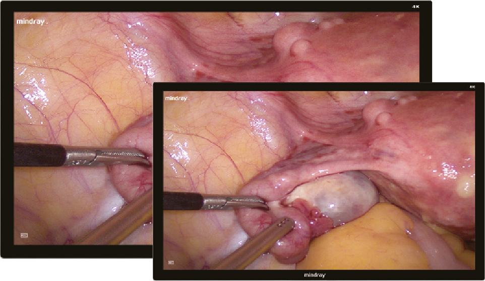 Видеоэндоскопическая система Mindray HyPixel U1 (4K UHD) фото2